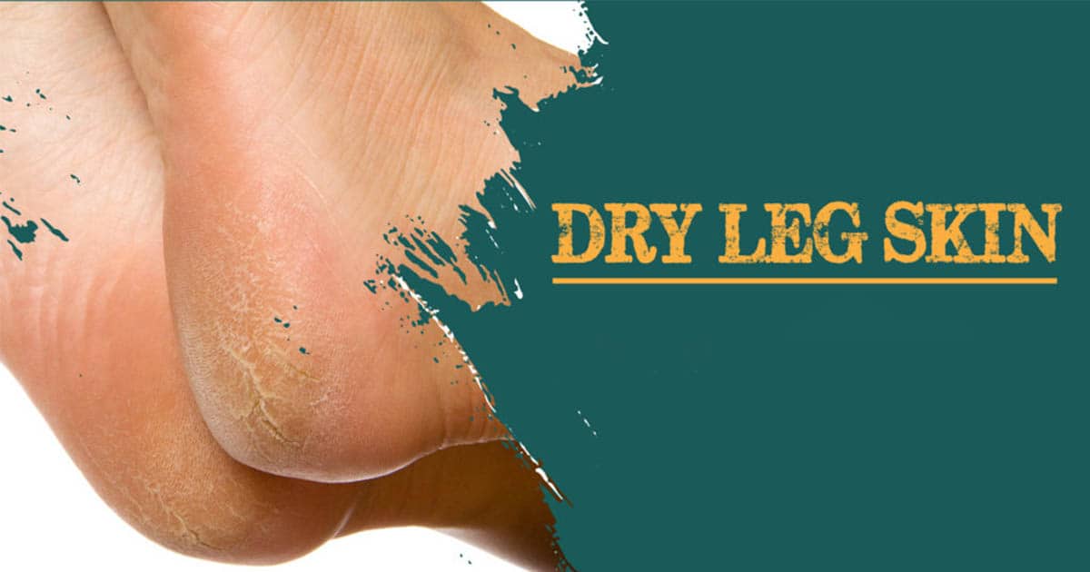 How To Heal Dry Skin On Legs