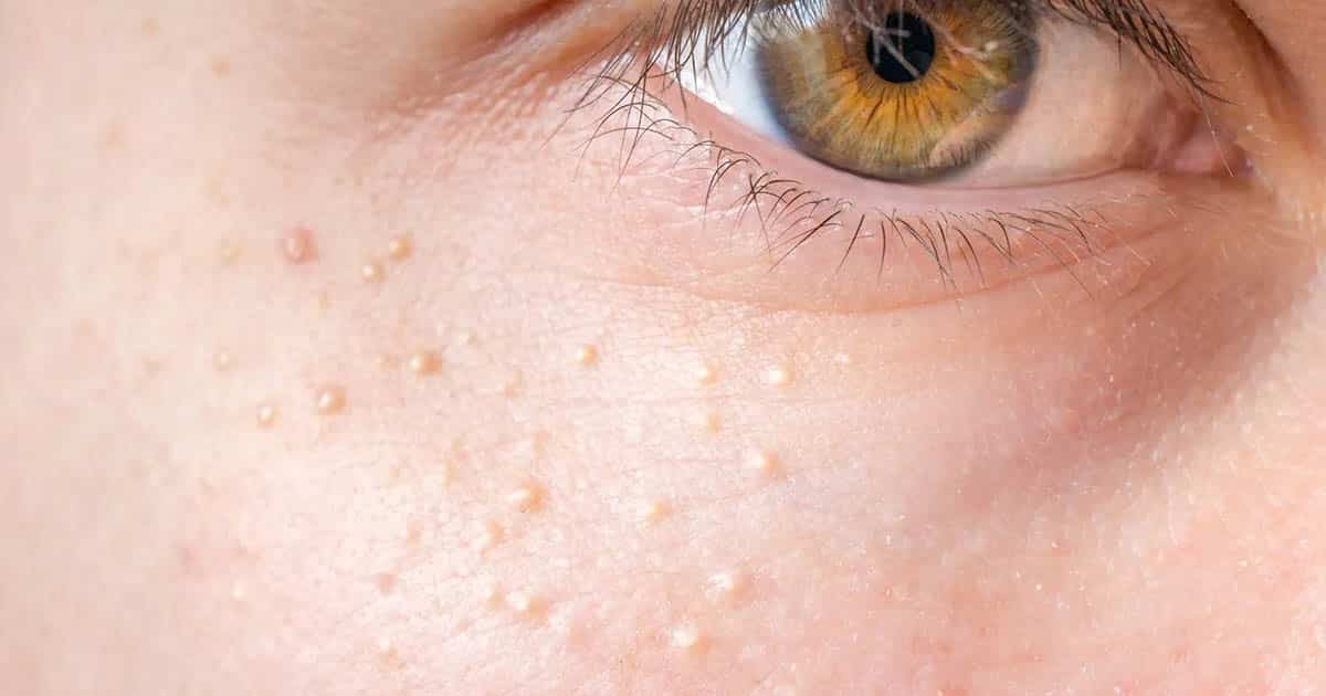 How To Remove Clogged Pores Under Your Eyes