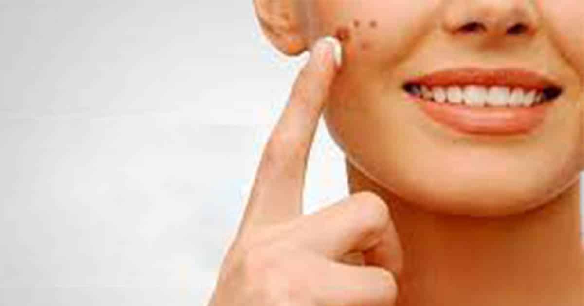 Instructions To Get Rid Of Spots On Your Skin Using Home Treatments
